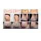 Liposonix ultrasonido focalizado de alta intensidad