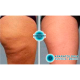 Vacumm portatil (anticelulitis)